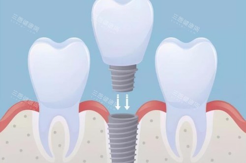 种植体植入卡通图