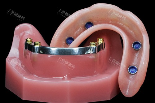 locator半固定种植牙修复种植体