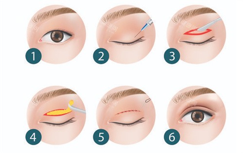 双眼皮全切手术过程