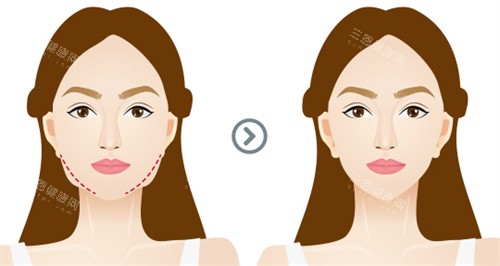 面部提升前后对比