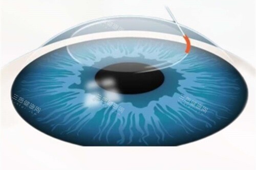 近视矫正眼球漫画示意图 近视矫正眼球漫画示意图