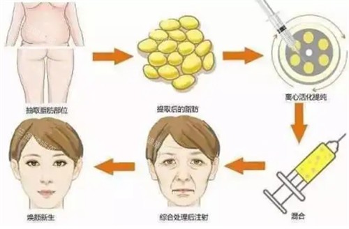 自体脂肪填充过程图解 自体脂肪填充过程图解