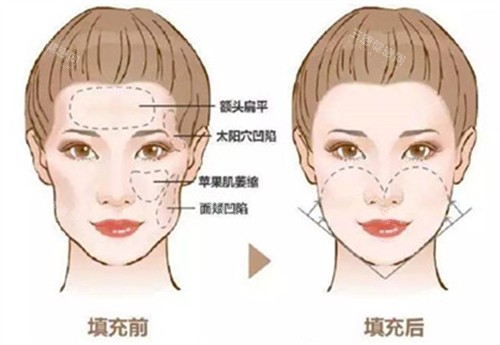自体脂肪填充前后对比图 自体脂肪填充前后对比图