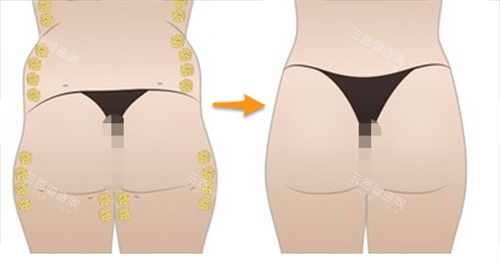 臀部脂肪填充过程展示图 臀部脂肪填充过程展示图