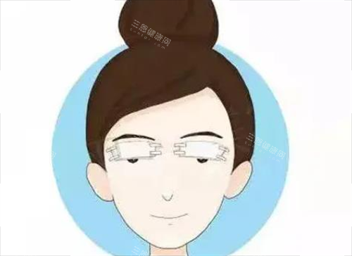 双眼皮术后