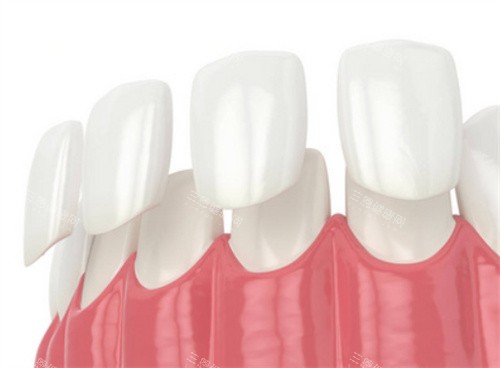 牙齿贴面动画展示图 牙齿贴面动画展示图