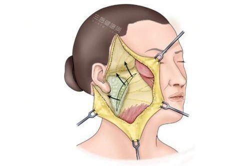 发际耳后切口拉皮手术示意图