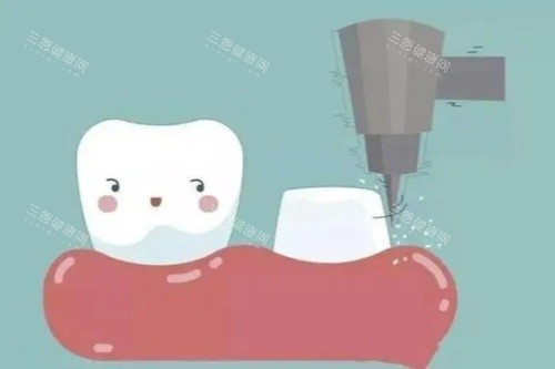 牙齿打桩卡通图 牙齿打桩卡通图