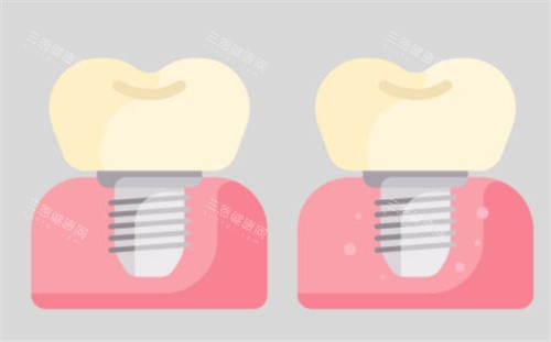 种植牙对比图