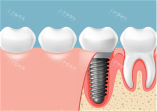 种植牙在口腔剖面图