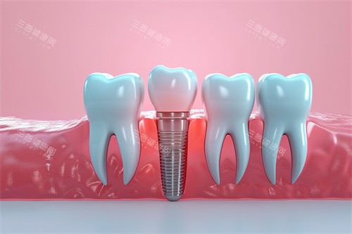 种植牙漫画模型解剖图