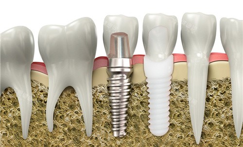 安卓健种植牙修复图 安卓健种植牙修复图