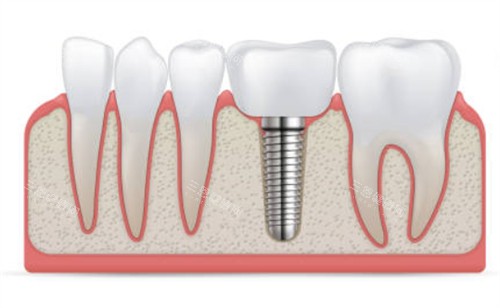 种植牙和临牙示意图