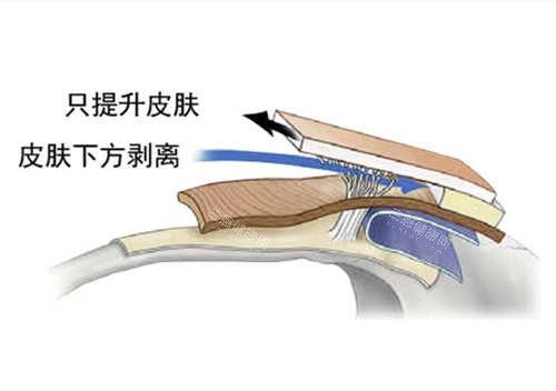 SMAS筋膜层图片 SMAS筋膜层图片