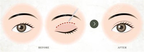 双眼皮术对比宣传图 双眼皮术对比宣传图