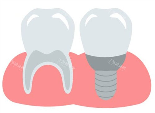 种植牙和牙齿图 种植牙和牙齿图