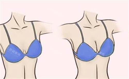 隆胸**对比 隆胸**对比