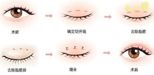双眼皮手术过程图