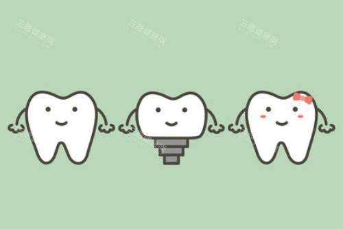 单颗种植牙卡通展示图 单颗种植牙卡通展示图