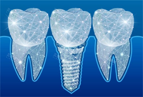 种植牙科技感卡通 种植牙科技感卡通