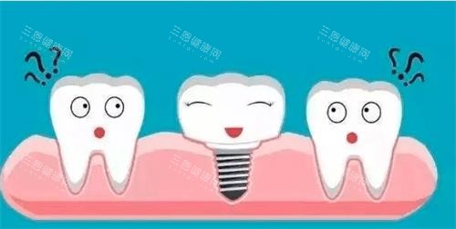 种植牙漫画演示图 种植牙漫画演示图
