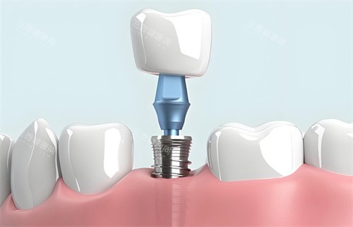 种植牙模型结构图片 种植牙模型结构图片