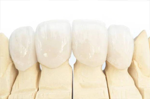 全瓷牙冠佩戴模型展示 全瓷牙冠佩戴模型展示