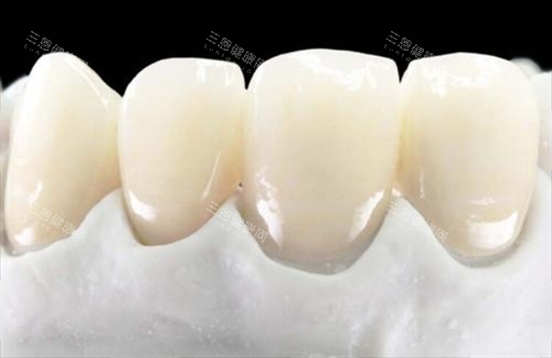 全瓷牙前牙展示 全瓷牙前牙展示