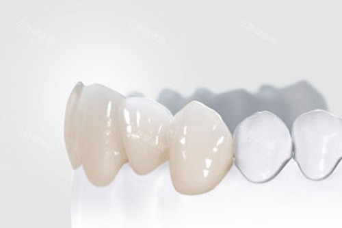 全瓷牙冠模型图 全瓷牙冠模型图