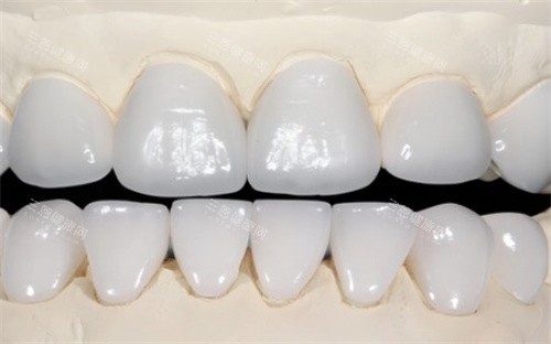 全口全瓷牙 全口全瓷牙