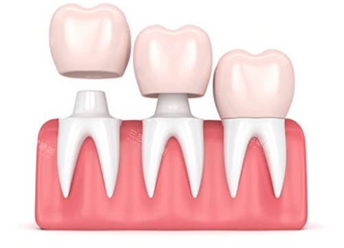 牙冠模型示意图 牙冠模型示意图