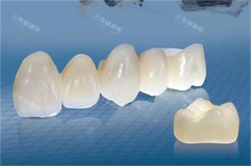 联排全瓷牙冠展示图 联排全瓷牙冠展示图