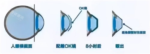 角膜塑形镜8小时后变化 角膜塑形镜8小时后变化