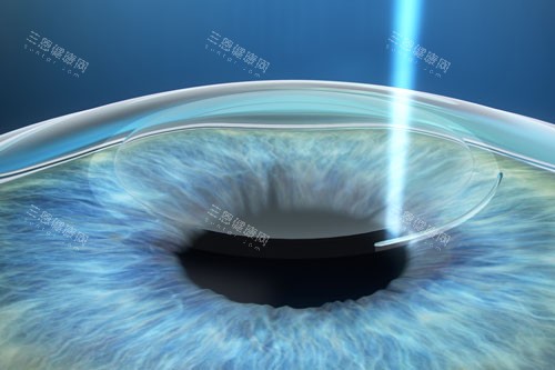 近视手术示意图 近视手术示意图