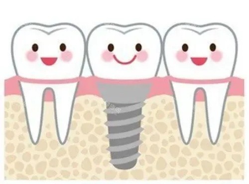 种牙的示意图