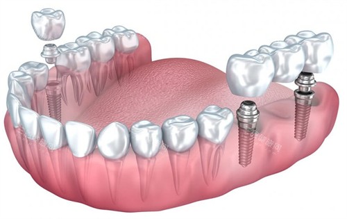 单颗烤瓷牙和连冠种植牙 单颗烤瓷牙和连冠种植牙