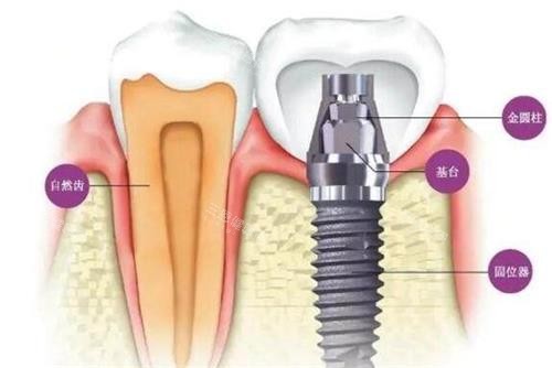 种植牙的组成介绍 种植牙的组成介绍