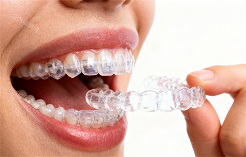 牙齿矫正图片 牙齿矫正图片