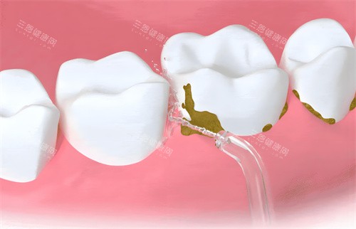 洗牙过程卡通图 洗牙过程卡通图