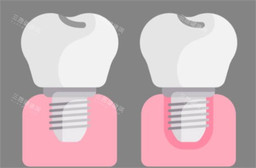 种植牙前后对比图 种植牙前后对比图