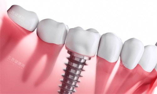 种植牙种植后的样子 种植牙种植后的样子
