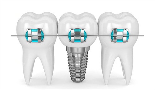 种植牙牙齿矫正图片 种植牙牙齿矫正图片