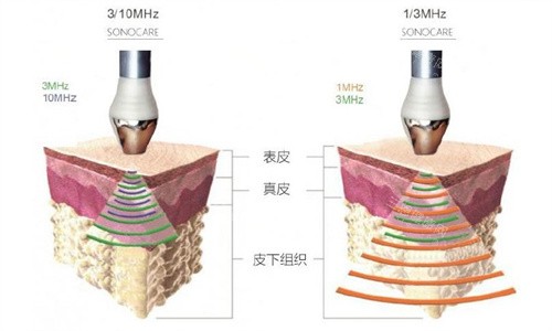做LDM水滴提升前必看：值不值得做？医生不告诉你的5件事