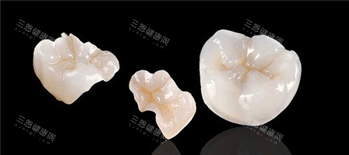 牙齿嵌体 牙齿嵌体