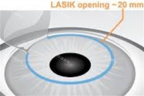 半飞秒制瓣示意图 半飞秒制瓣示意图