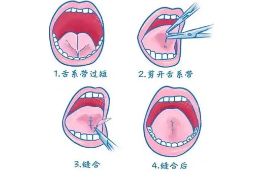 舌系带手术的动画图 舌系带手术的动画图