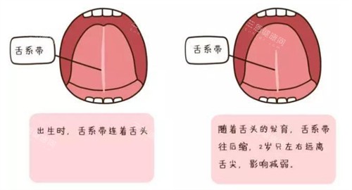 舌系带过短的样子 舌系带过短的样子