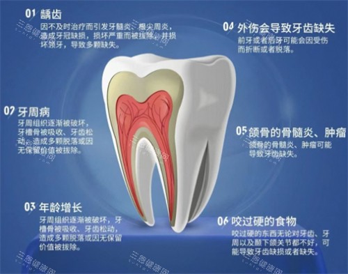 牙齿缺失原因 牙齿缺失原因