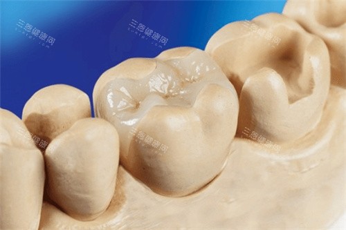 补牙嵌体修复结果 补牙嵌体修复结果