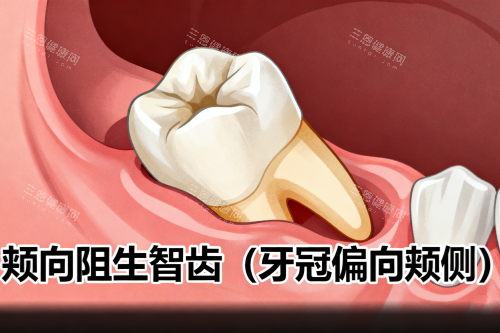 颊向阻生智齿展示图一览 颊向阻生智齿展示图一览